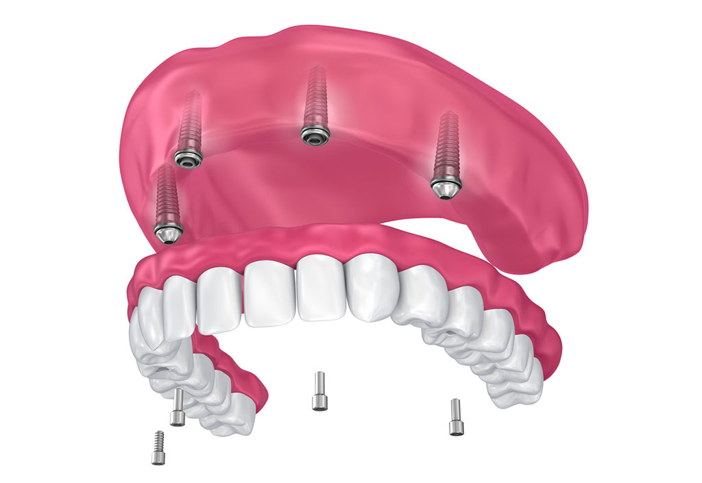 Implantes Nova Odonto