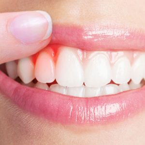Gengivite e periodontite — prevenção, controle e tratamento