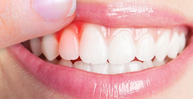 Gengivite e periodontite — prevenção, controle e tratamento